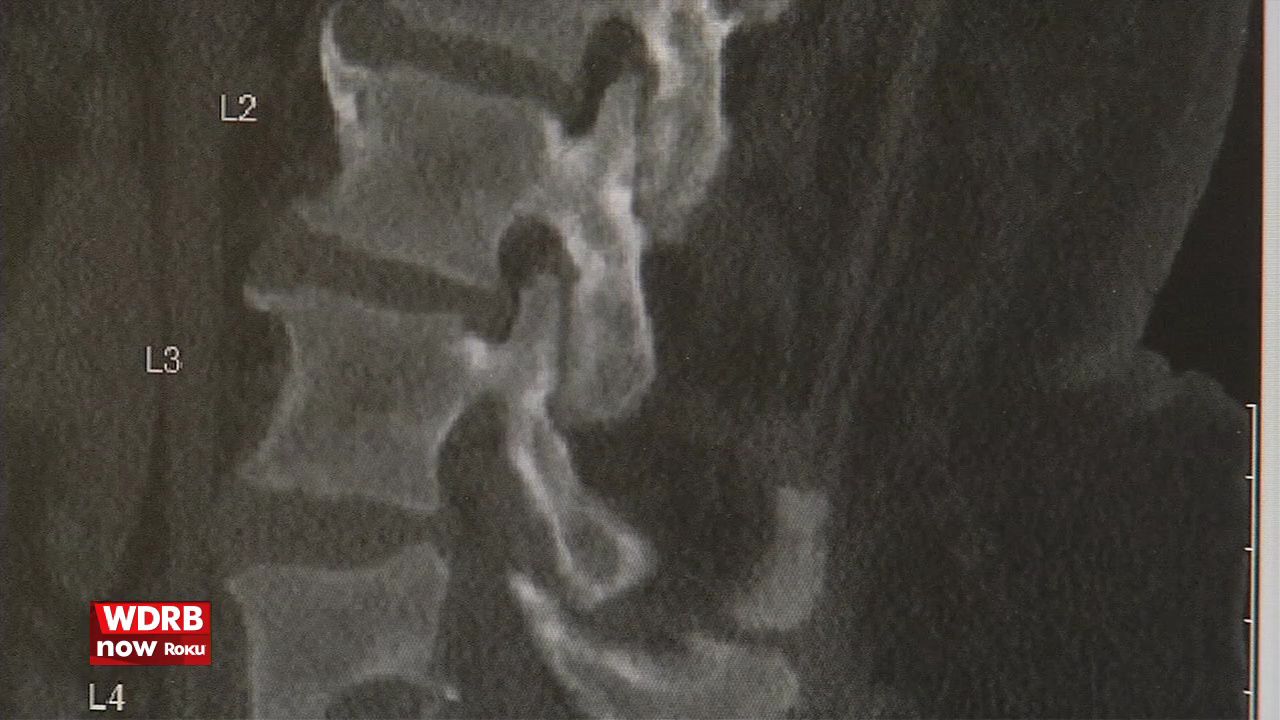 Increase in rare spine infection in Louisville linked to heroin epidemic